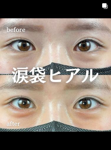 涙袋ヒアルロン酸の症例写真