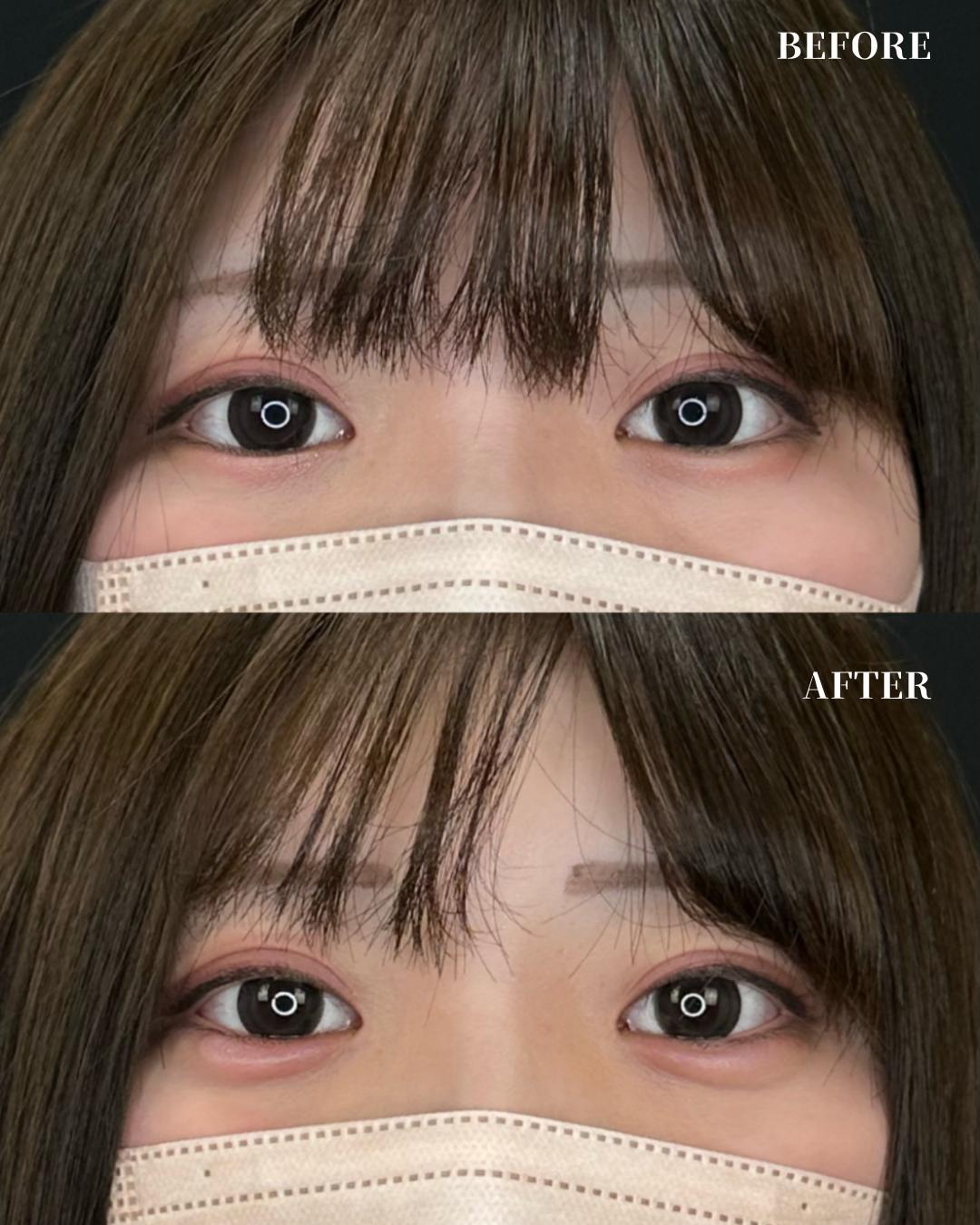 涙袋ヒアルロン酸の症例写真