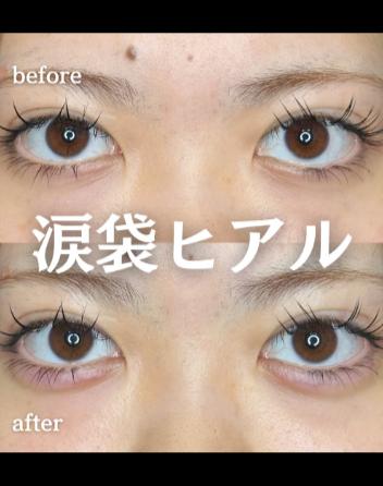 涙袋ヒアルロン酸の症例写真