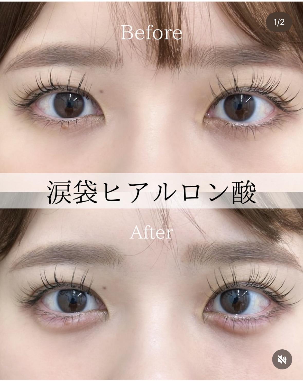 涙袋ヒアルロン酸の症例写真