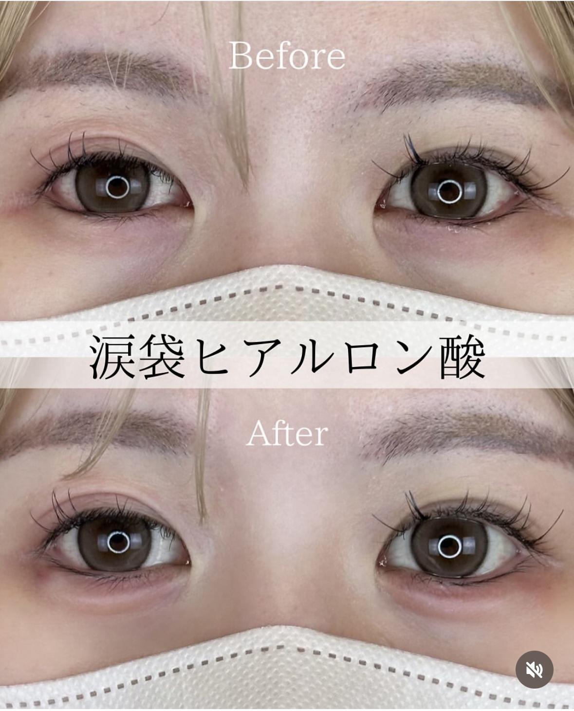 涙袋ヒアルロン酸の症例写真