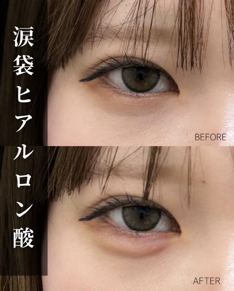 涙袋ヒアルロン酸の症例写真