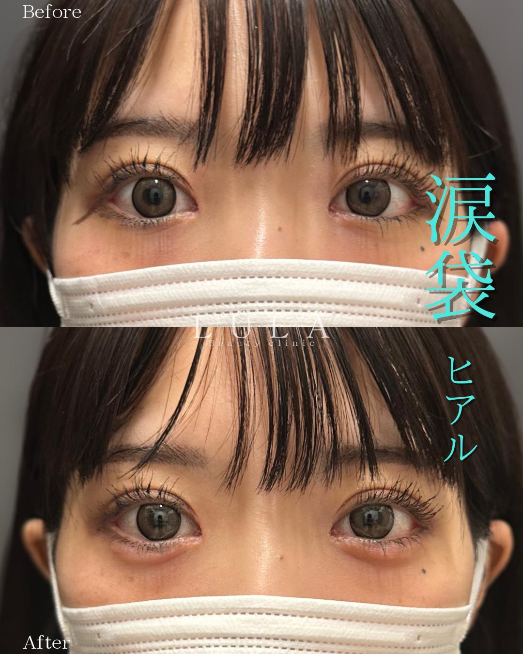 涙袋ヒアルロン酸の症例写真