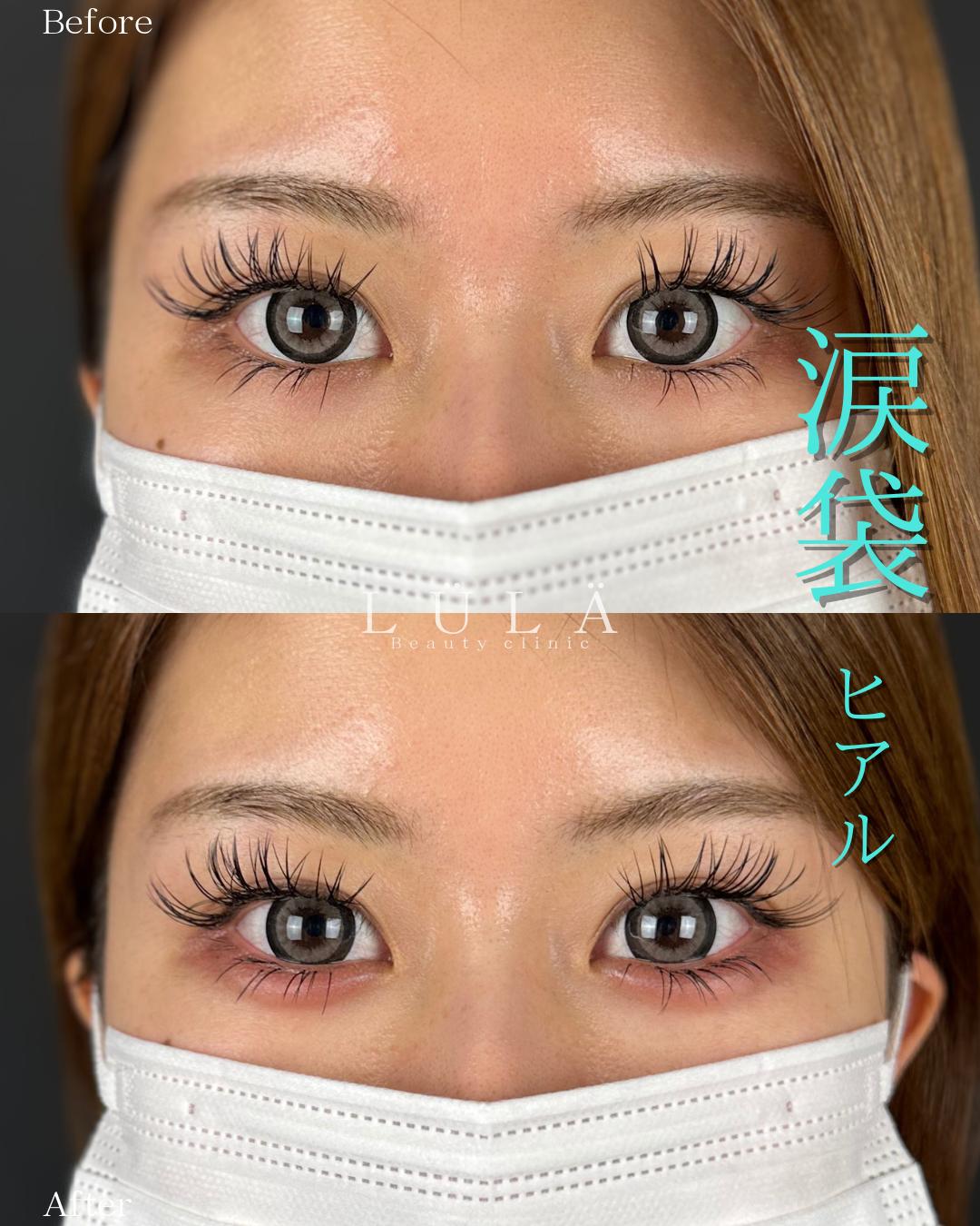 涙袋ヒアルロン酸の症例写真