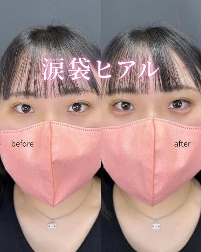 涙袋ヒアルロン酸の症例写真