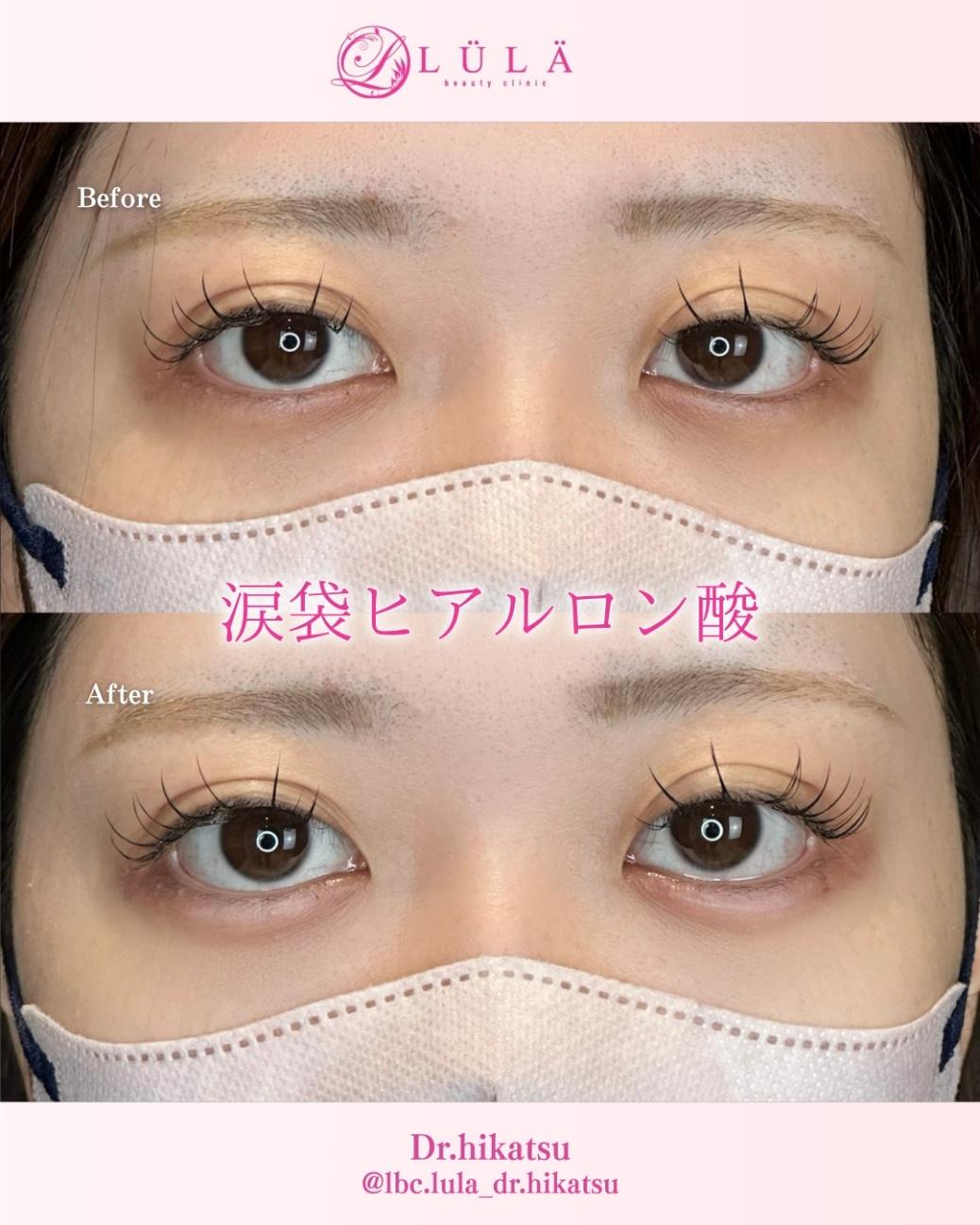 涙袋ヒアルロン酸の症例写真