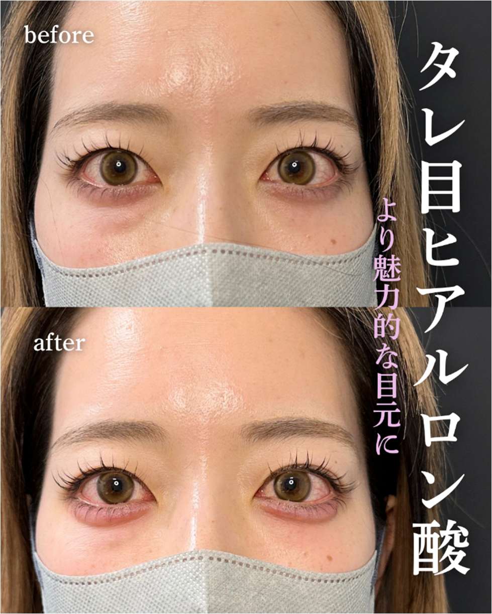 涙袋ヒアルロン酸の症例写真