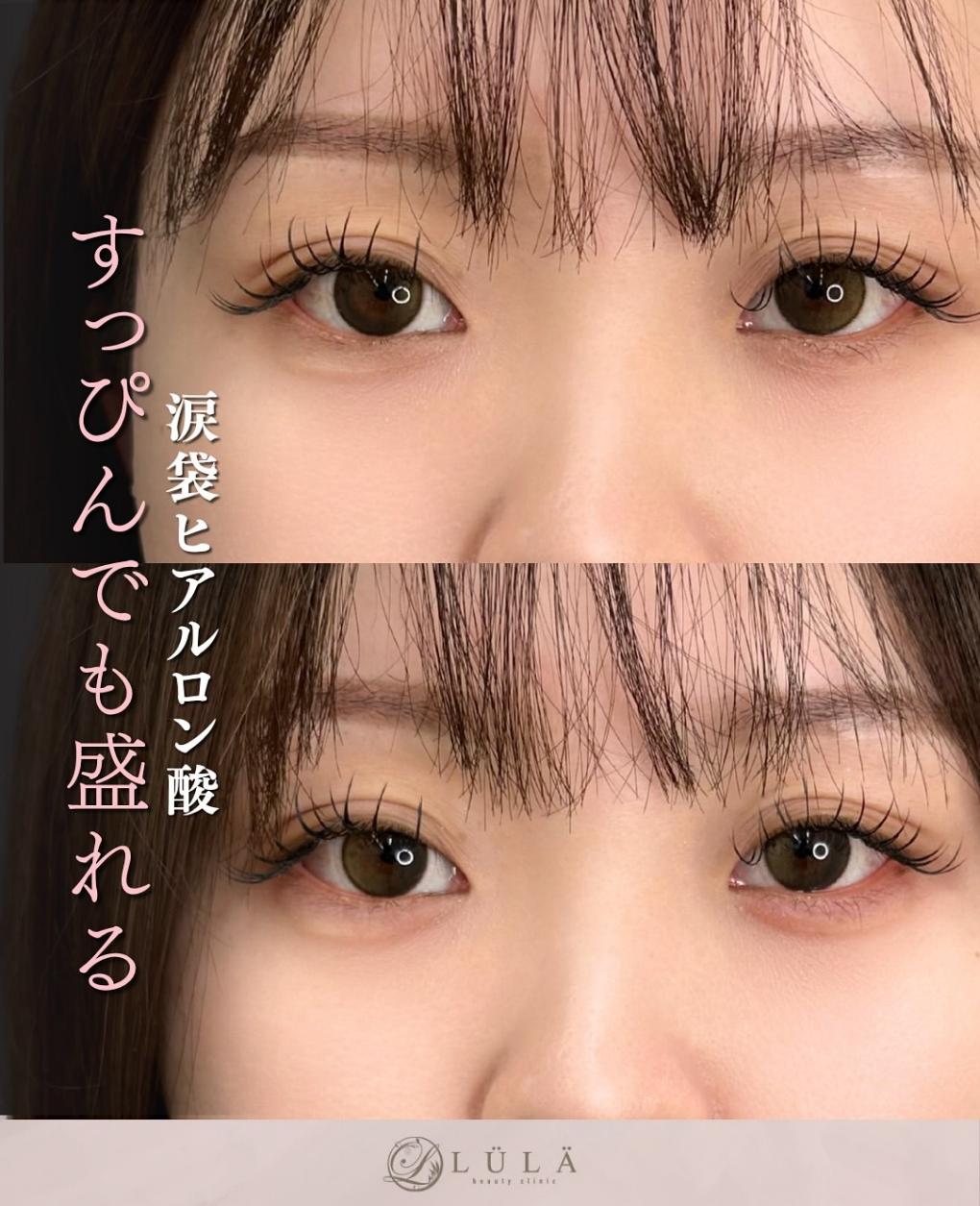 涙袋ヒアルロン酸の症例写真