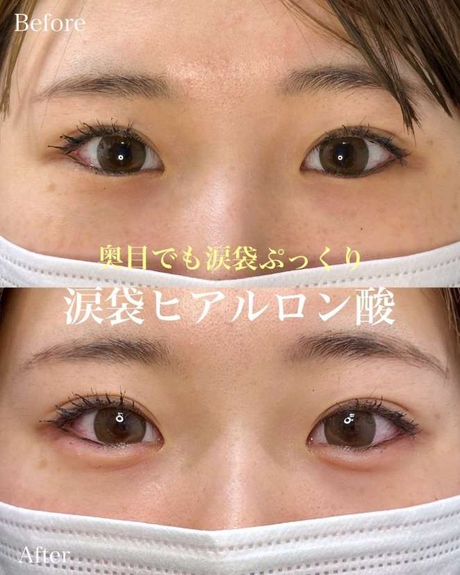 涙袋ヒアルロン酸の症例写真