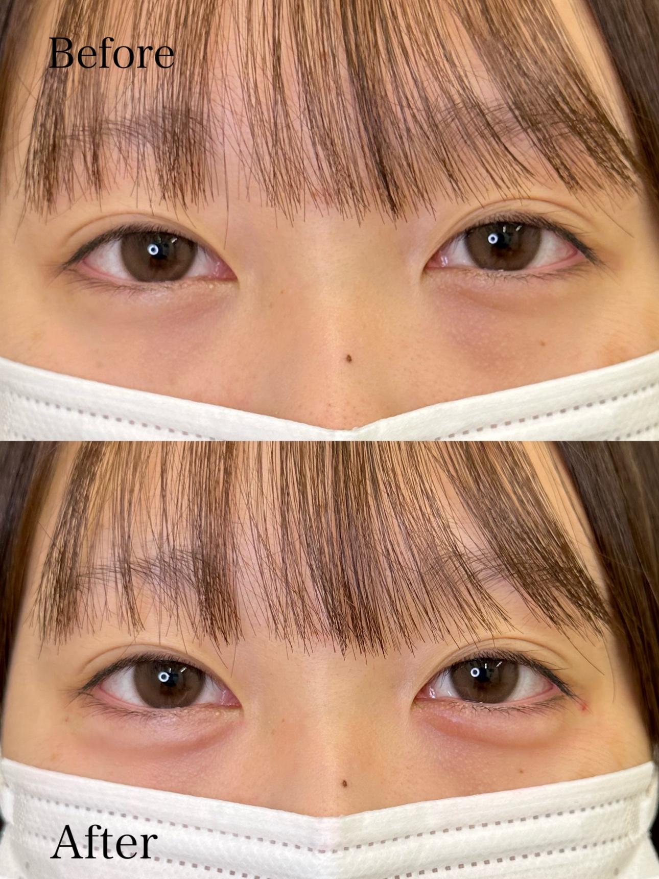 涙袋ヒアルロン酸の症例写真