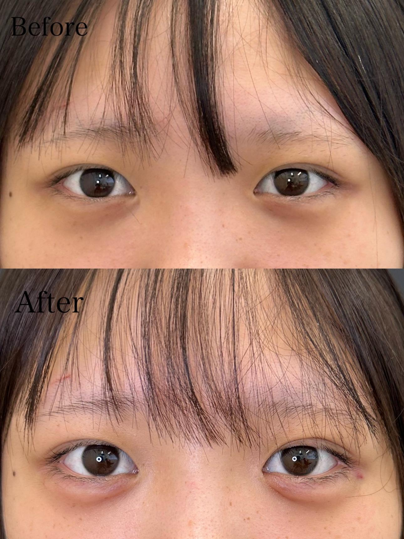 涙袋ヒアルロン酸の症例写真