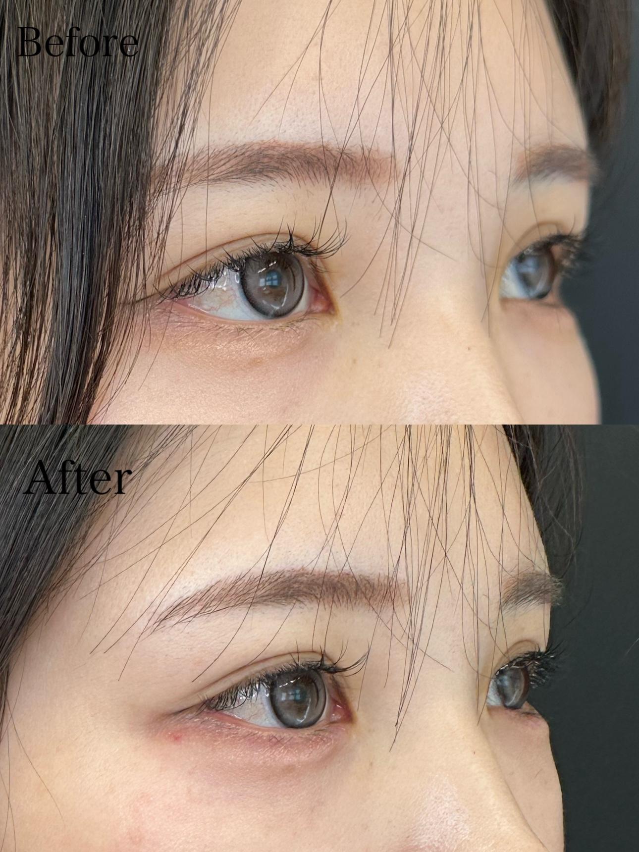 涙袋ヒアルロン酸の症例写真