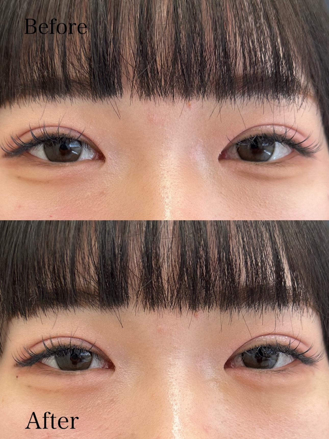 涙袋ヒアルロン酸の症例写真