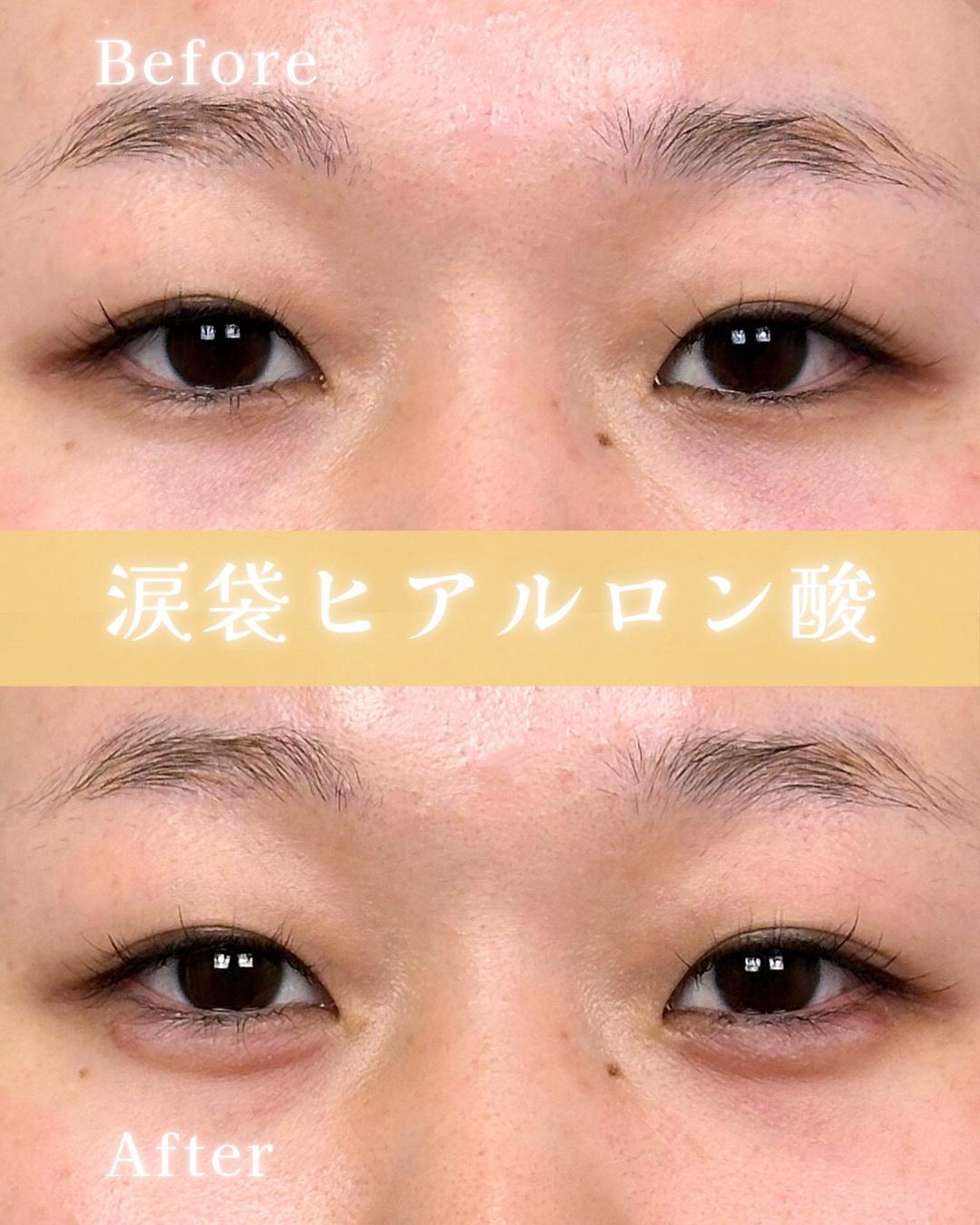 涙袋ヒアルロン酸の症例写真