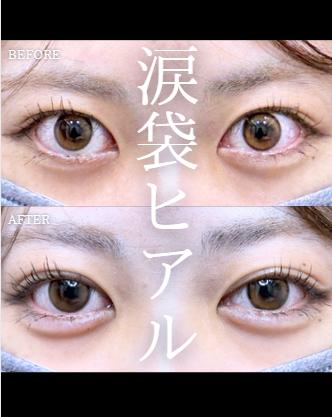 涙袋ヒアルロン酸の症例写真