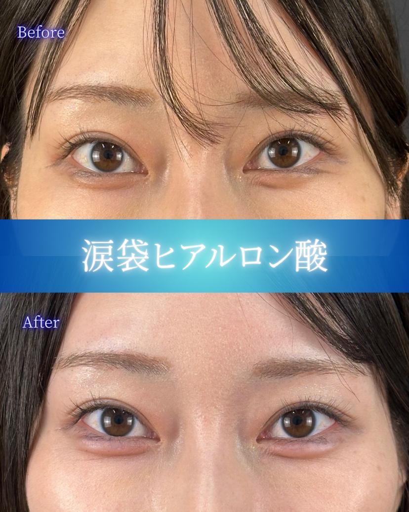 涙袋ヒアルロン酸の症例写真