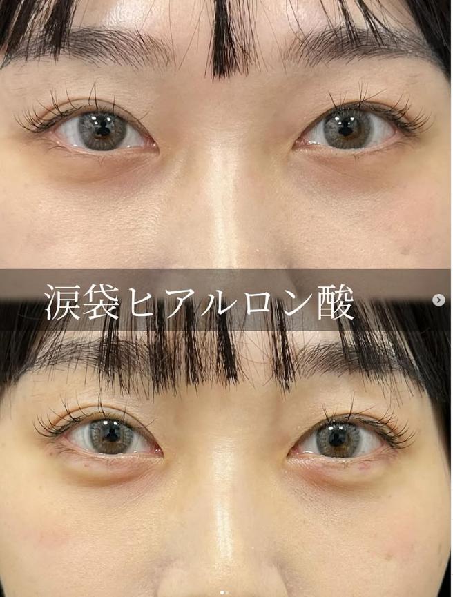 涙袋ヒアルロン酸の症例写真