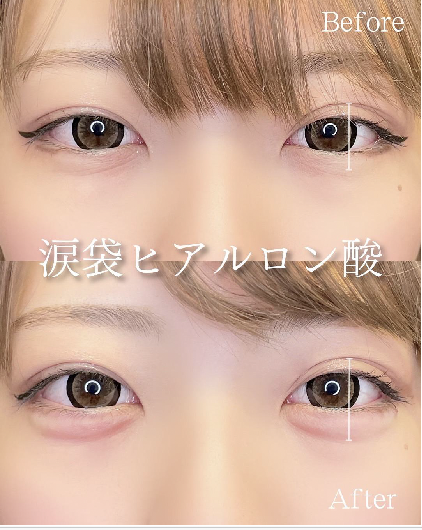 涙袋ヒアルロン酸の症例写真