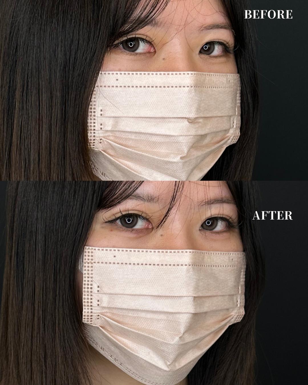 涙袋ヒアルロン酸の症例写真