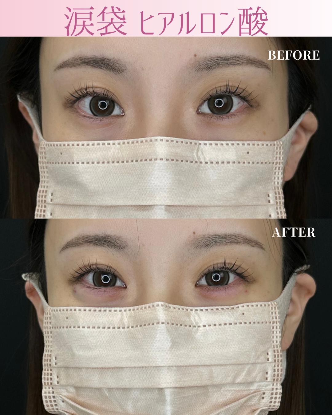 涙袋ヒアルロン酸の症例写真