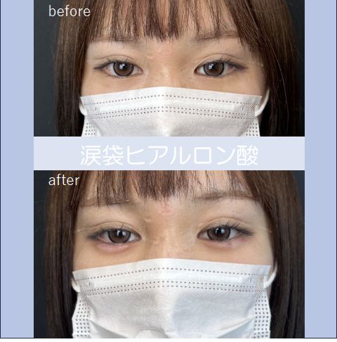 涙袋ヒアルロン酸の症例写真