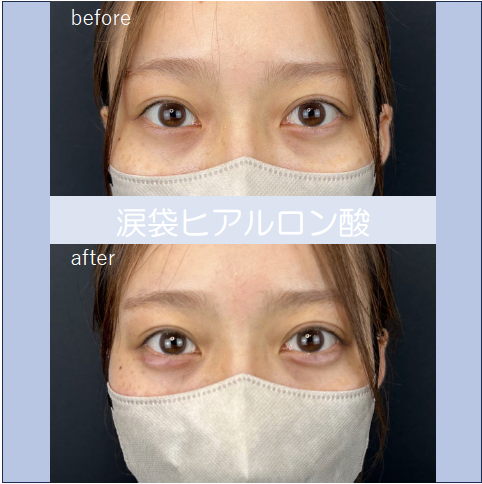 涙袋ヒアルロン酸の症例写真