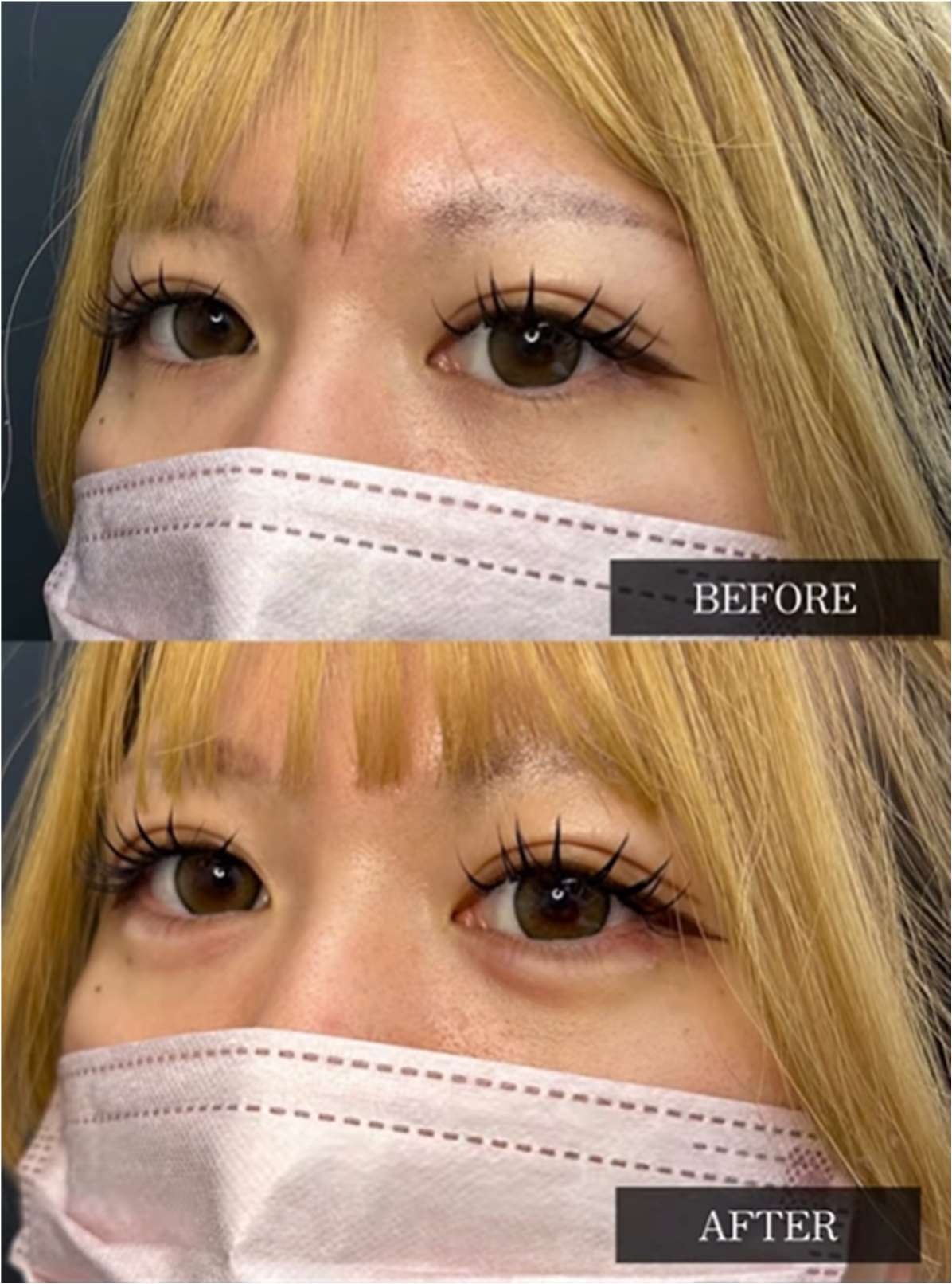 涙袋ヒアルロン酸の症例写真