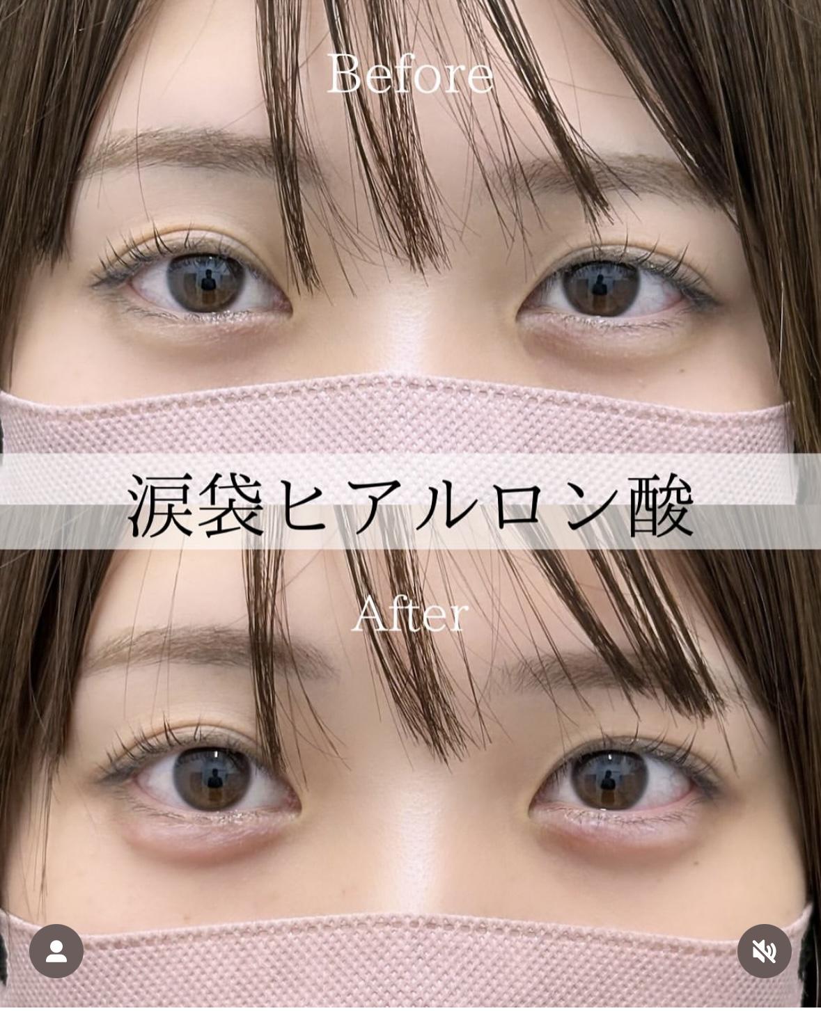 涙袋ヒアルロン酸の症例写真
