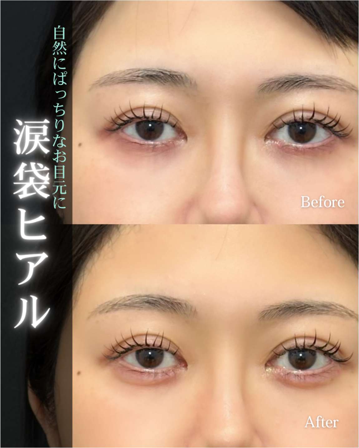 涙袋ヒアルロン酸の症例写真