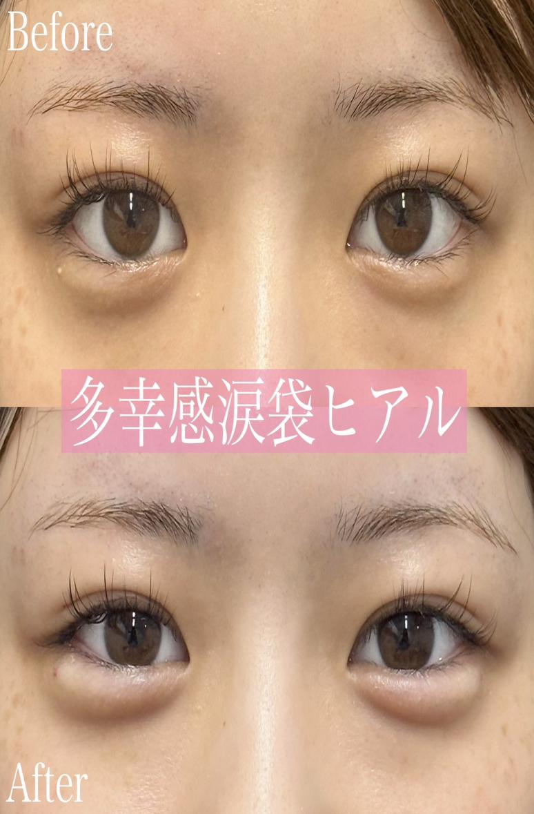 涙袋ヒアルロン酸の症例写真