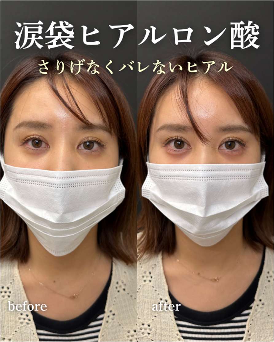 涙袋ヒアルロン酸の症例写真