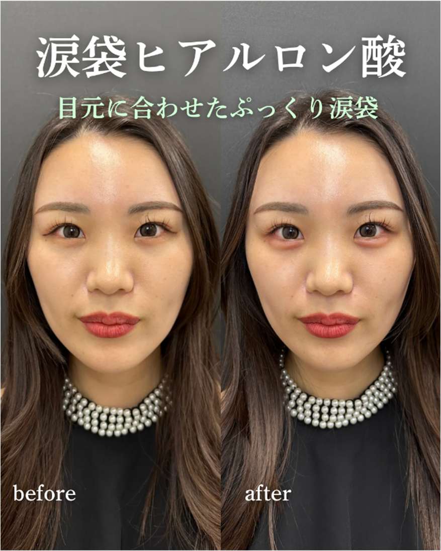 涙袋ヒアルロン酸の症例写真