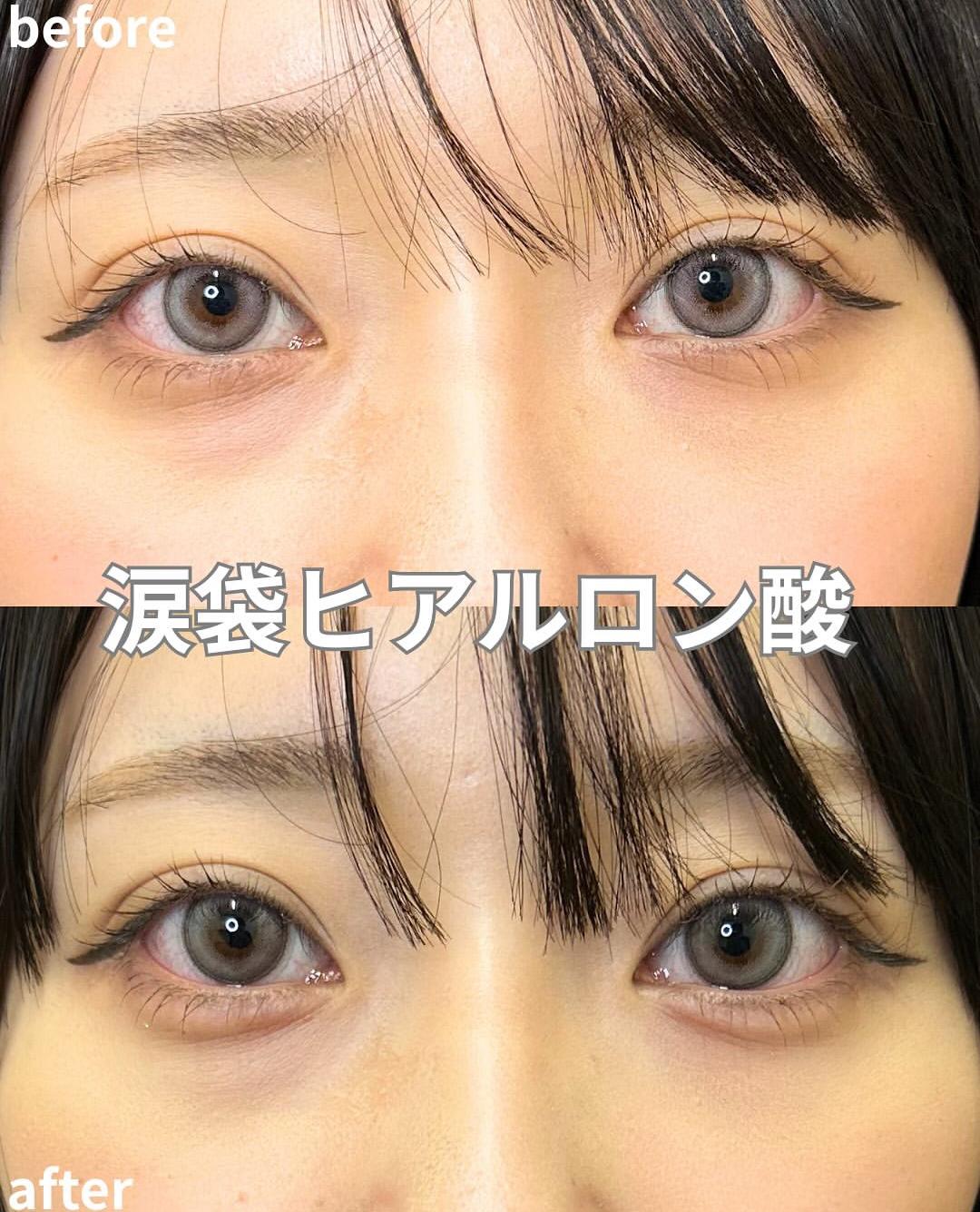 涙袋ヒアルロン酸の症例写真