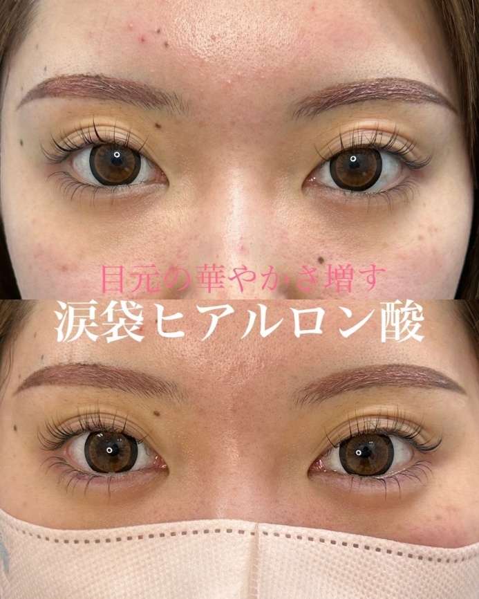 涙袋ヒアルロン酸の症例写真