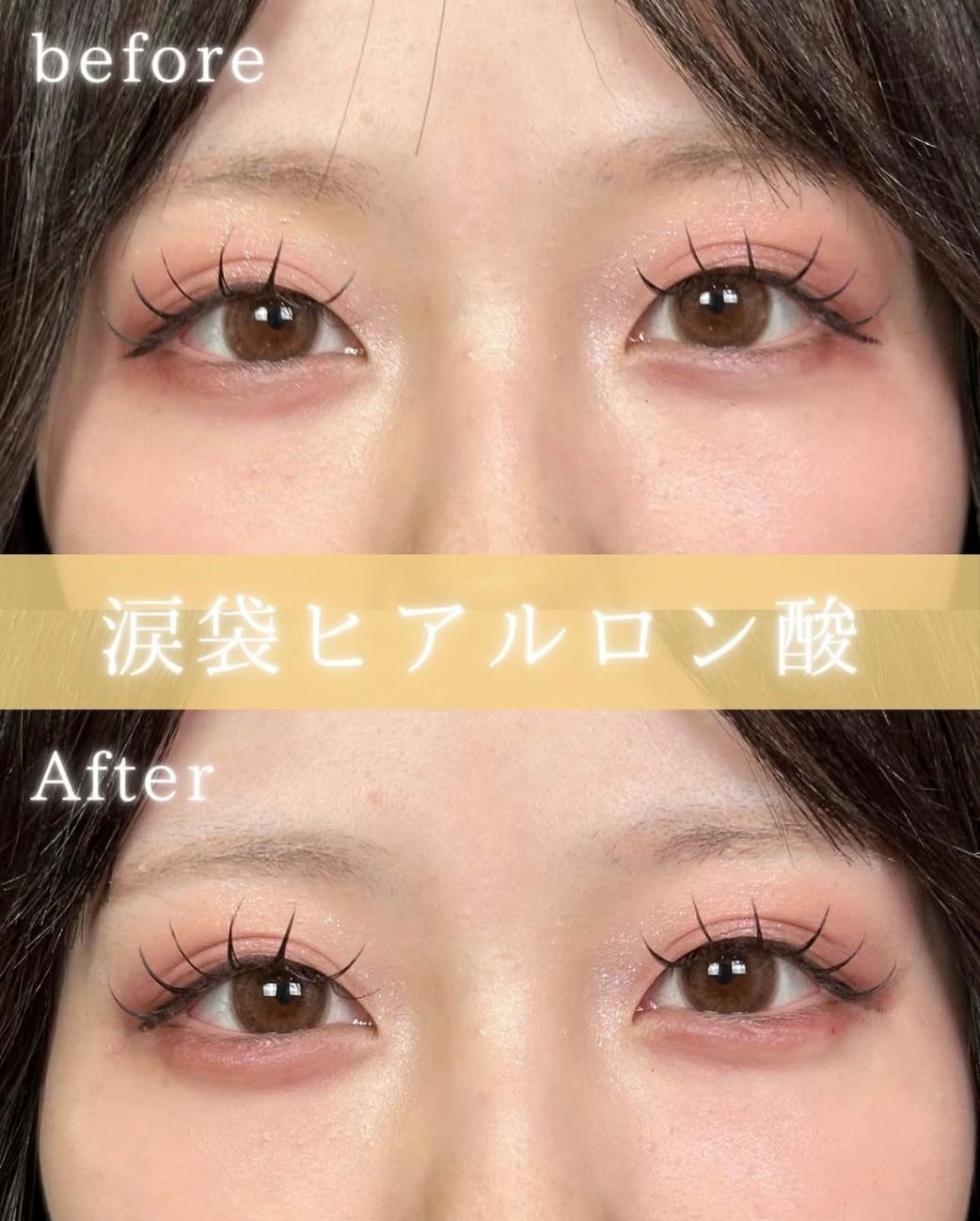 涙袋ヒアルロン酸の症例写真