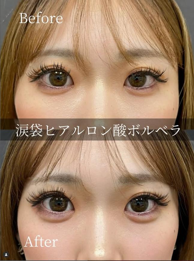 涙袋ヒアルロン酸の症例写真