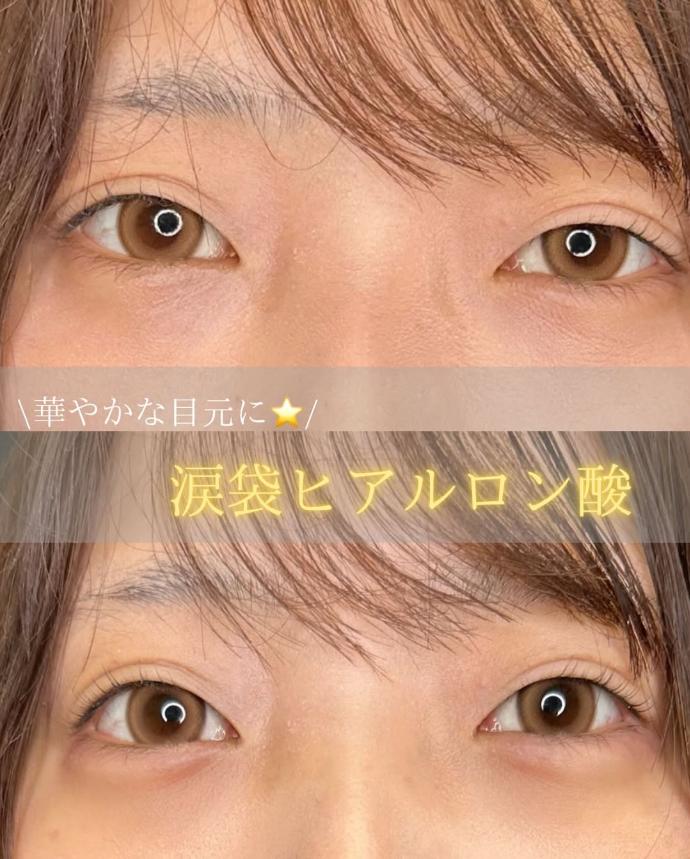 涙袋ヒアルロン酸の症例写真