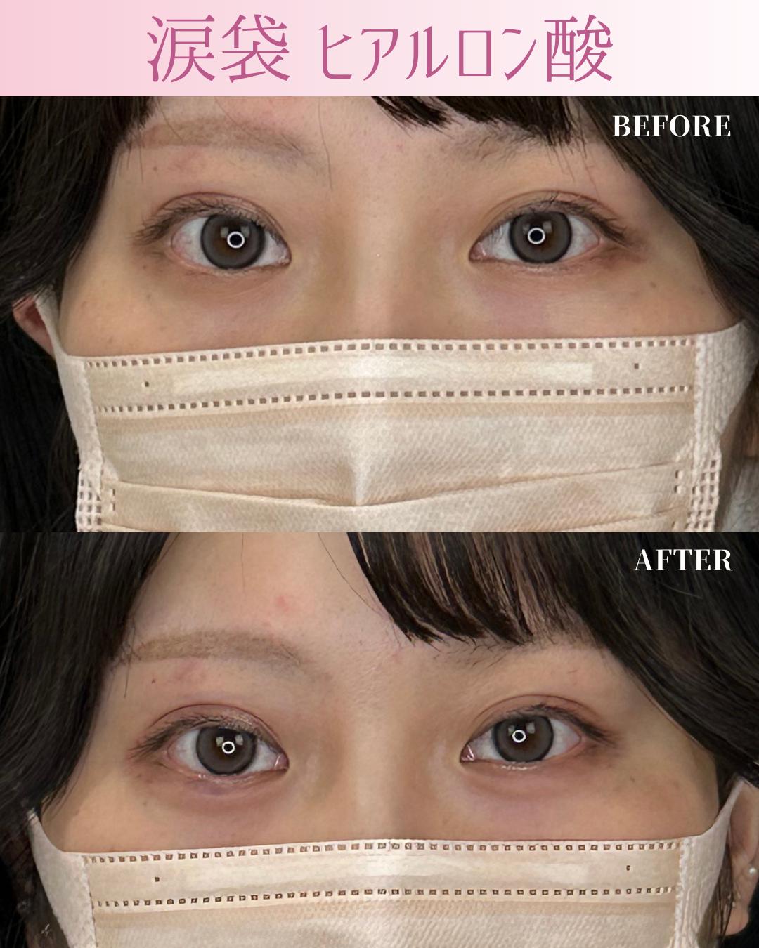 涙袋ヒアルロン酸の症例写真