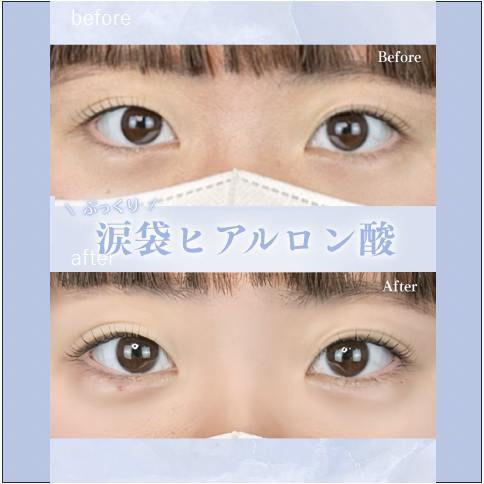 涙袋ヒアルロン酸の症例写真