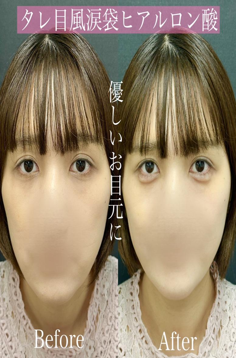 涙袋ヒアルロン酸の症例写真