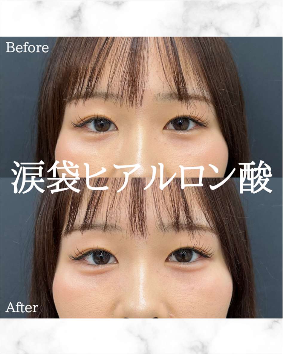 涙袋ヒアルロン酸の症例写真