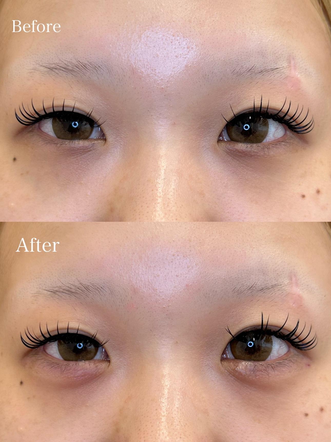 涙袋ヒアルロン酸の症例写真