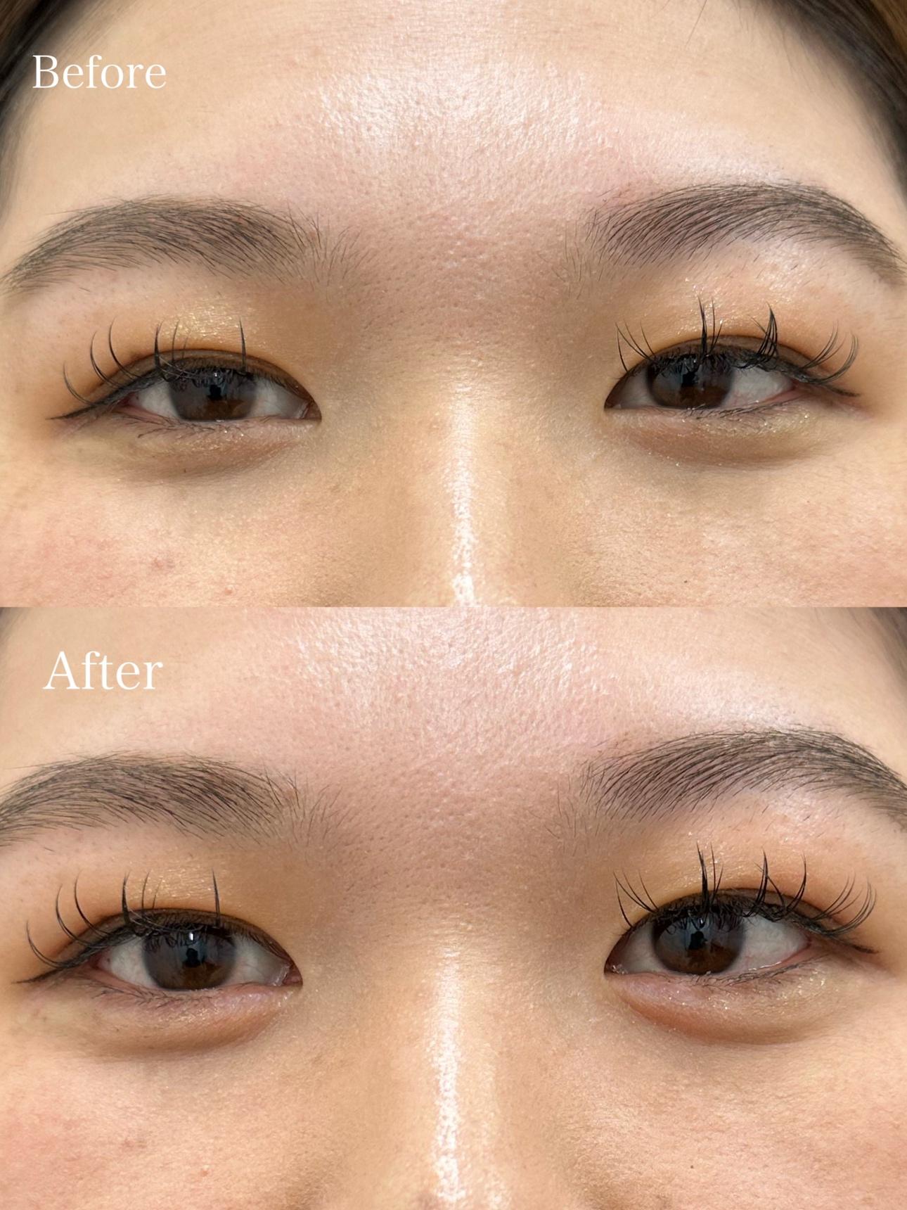 涙袋ヒアルロン酸の症例写真