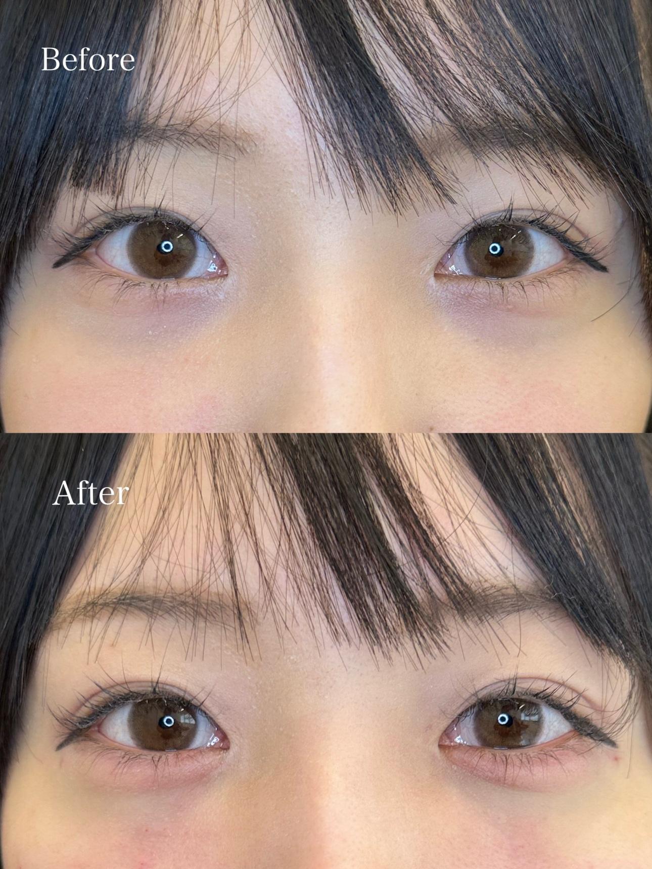 涙袋ヒアルロン酸の症例写真