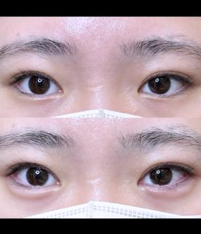 涙袋ヒアルロン酸の症例写真