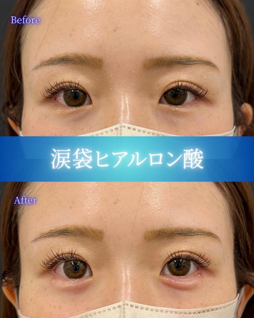 涙袋ヒアルロン酸の症例写真