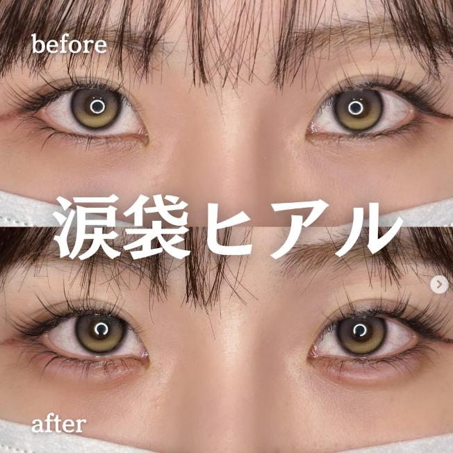 涙袋ヒアルロン酸の症例写真