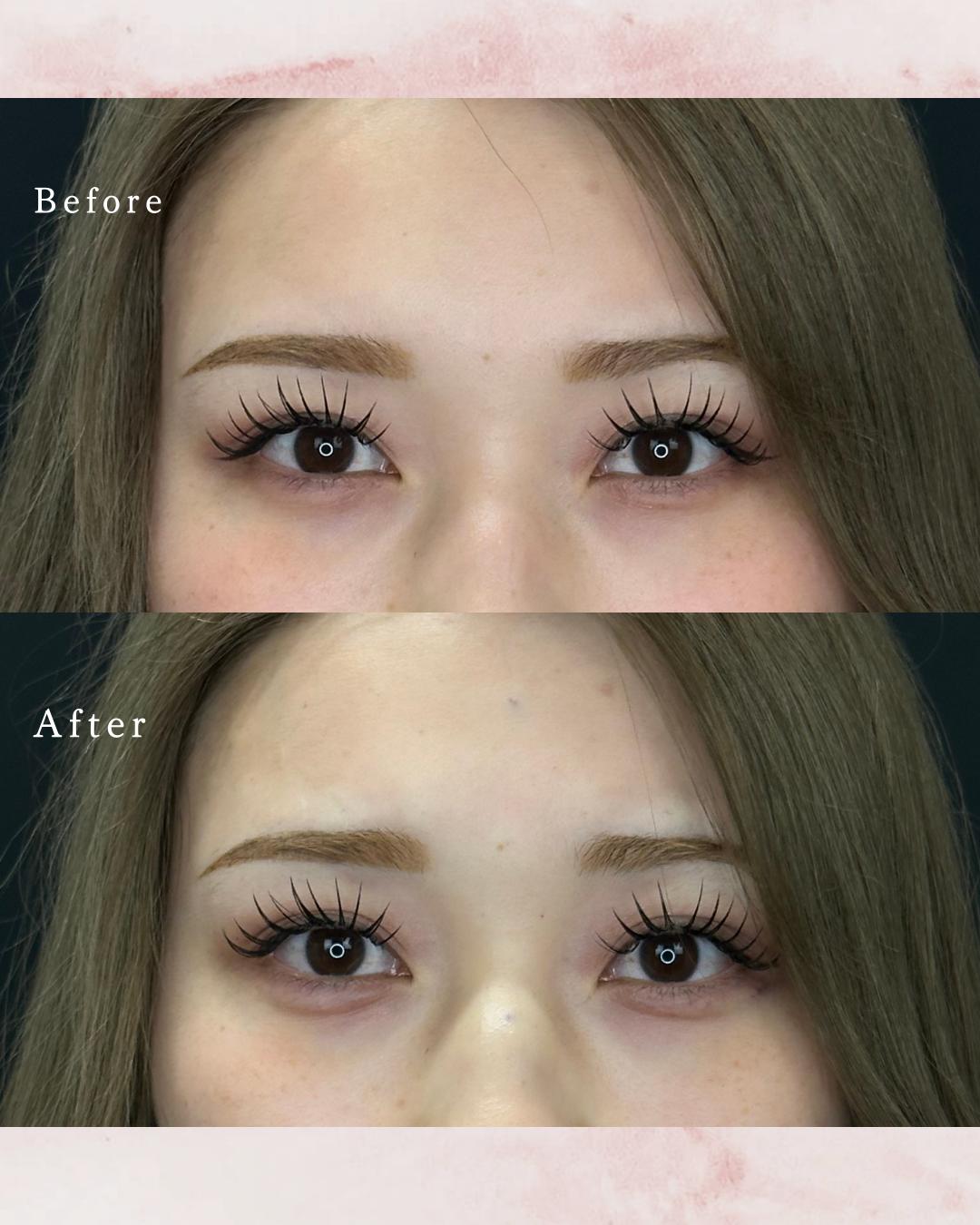 涙袋ヒアルロン酸の症例写真