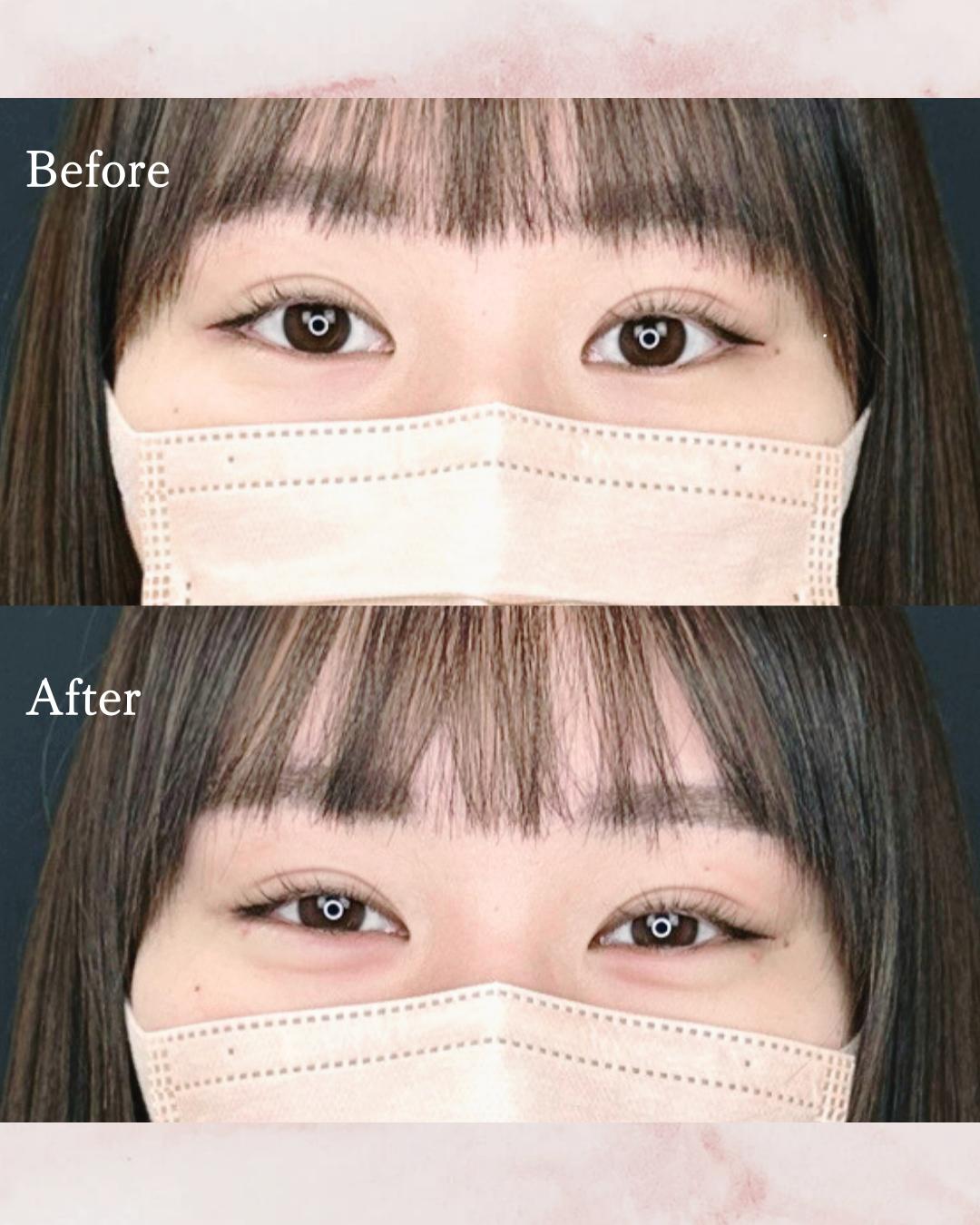 涙袋ヒアルロン酸の症例写真