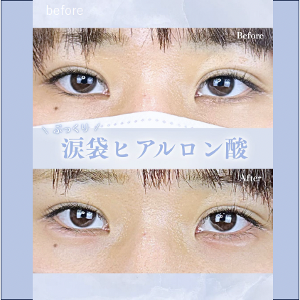 涙袋ヒアルロン酸の症例写真